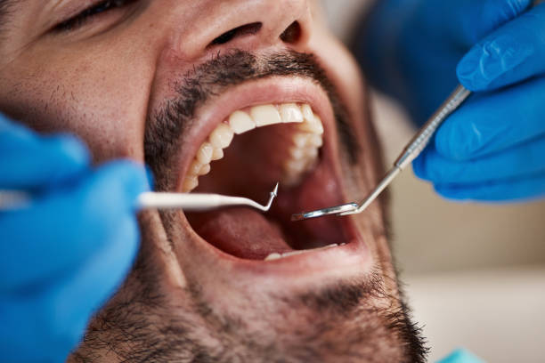 Dental Inlays and Onlays in Centreville, IL